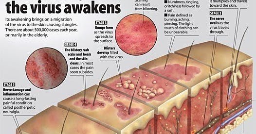 shingles cause and disease