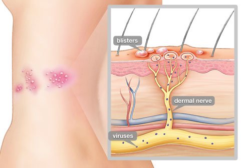 shingles cause and disease