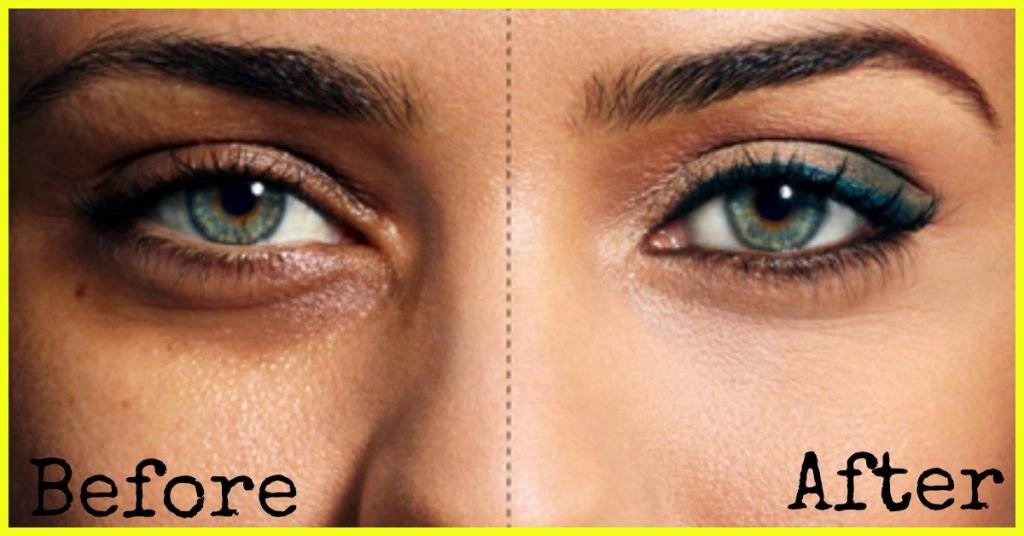 how to remove dark circles permanently