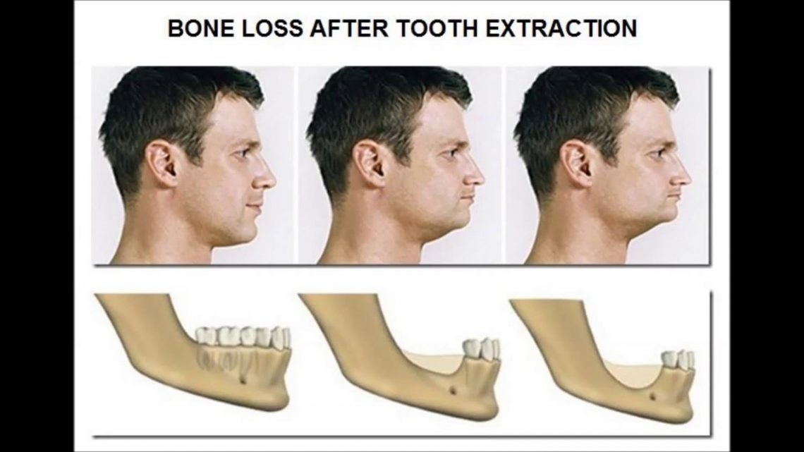 "Tips to Maintain Strong Teeth and Prevent Dental Bone Loss"